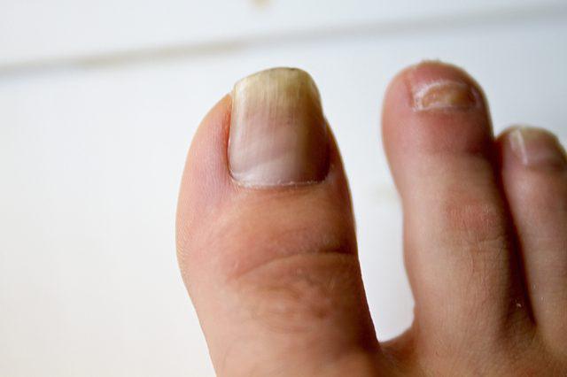 Why Is Toenail Fungus So Difficult to Treat? | University Hospitals