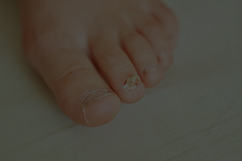 Nail Fungus